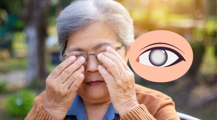 Cataract