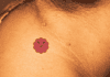 Skin Tags