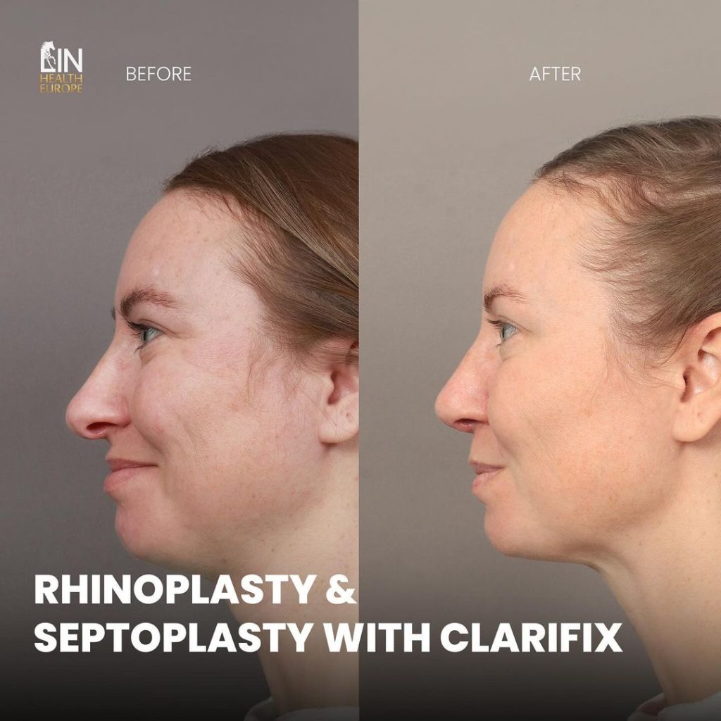 before-after-1-lin
