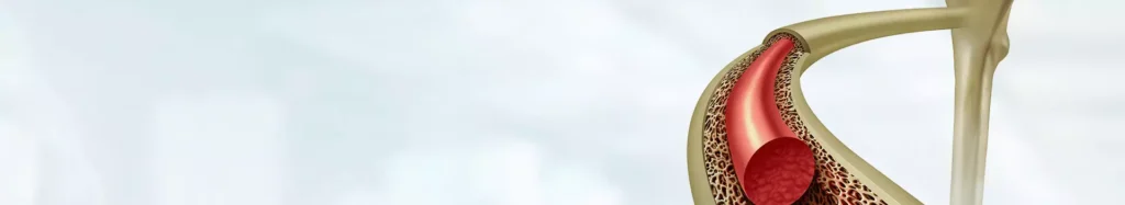 Bone Marrow Transplant Adult