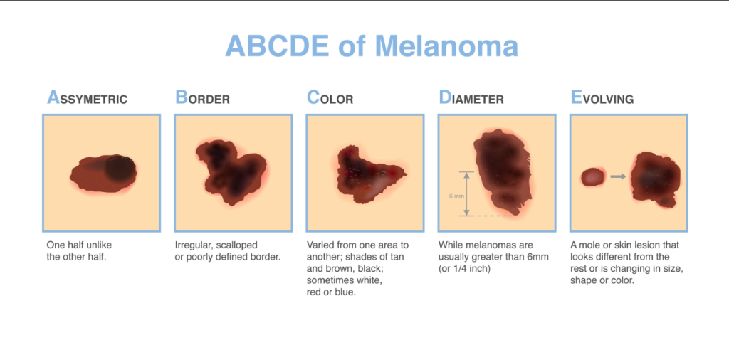 a b c d e del melanoma