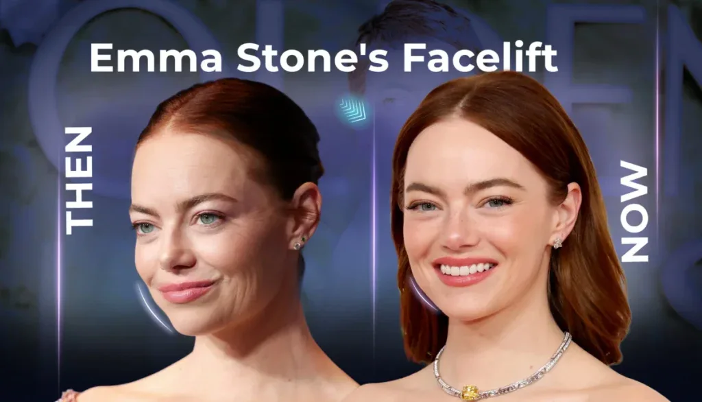 emma stone face lift
