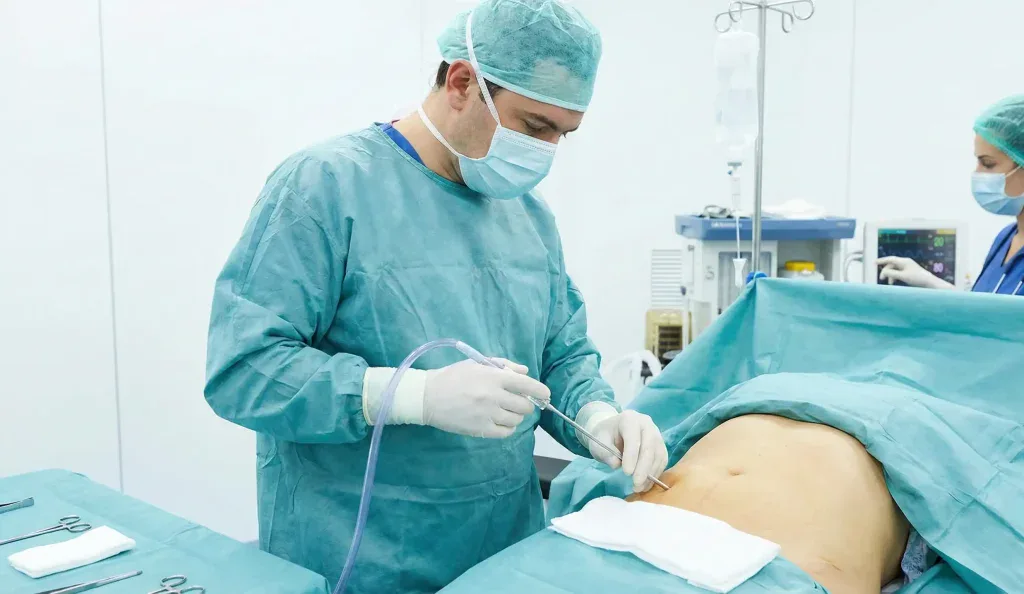 procedura di liposuzione sala operatoria