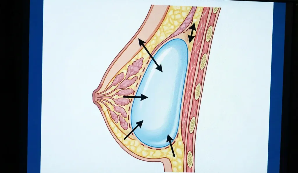 Anatomische Darstellung der Brustimplantat-Positionierung