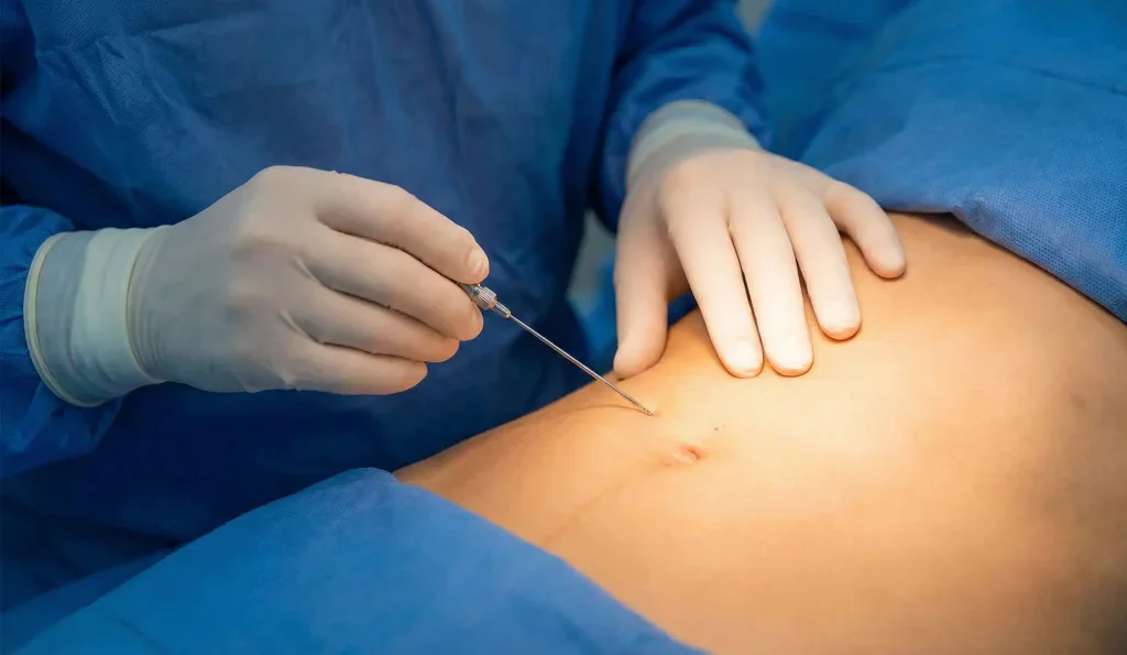 liposculpture procedure detailed fat sculpting with thin cannula