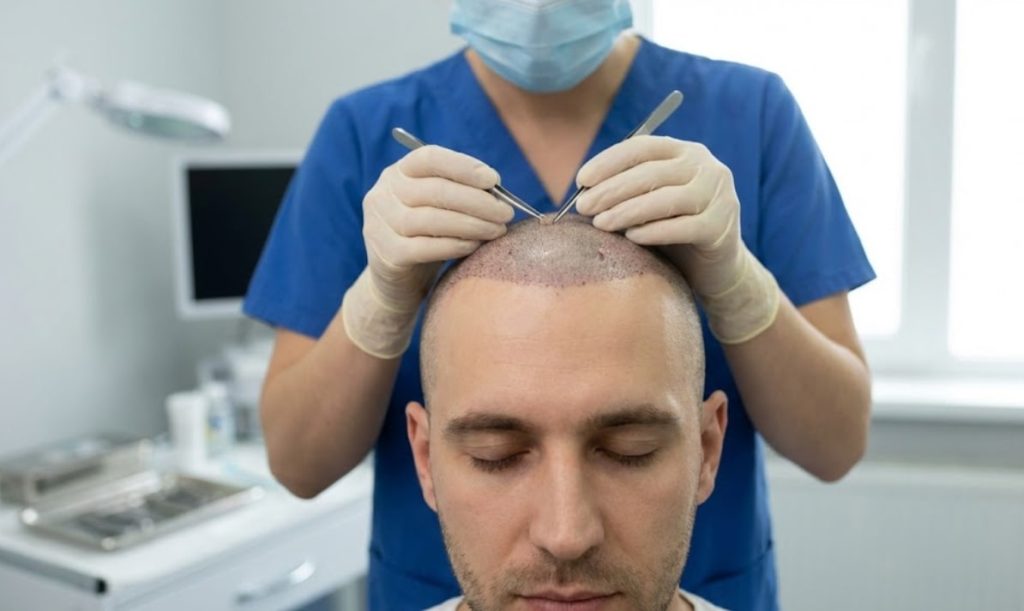 Haartransplantationsverfahren, Seitenansicht, Nahaufnahme der Chirurgenhände
