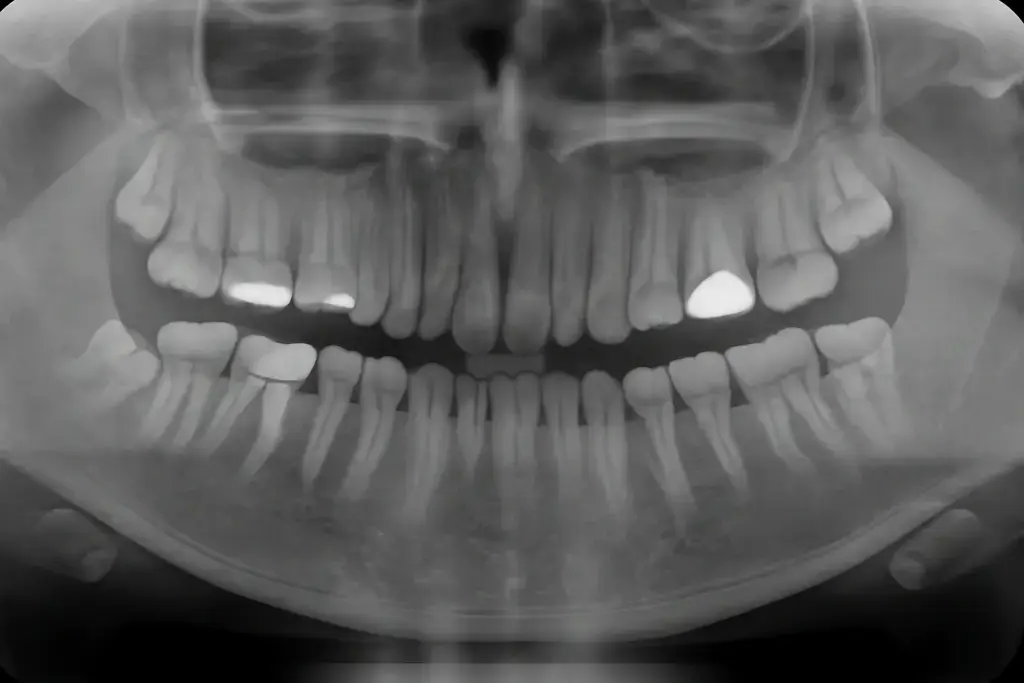 dental-code-for-6-vertical-bitewings