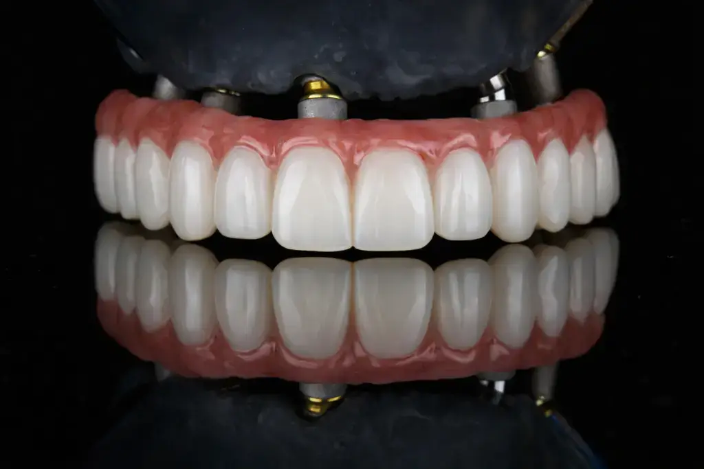 combien-de-temps-durent-les-implants-dentaires-complets