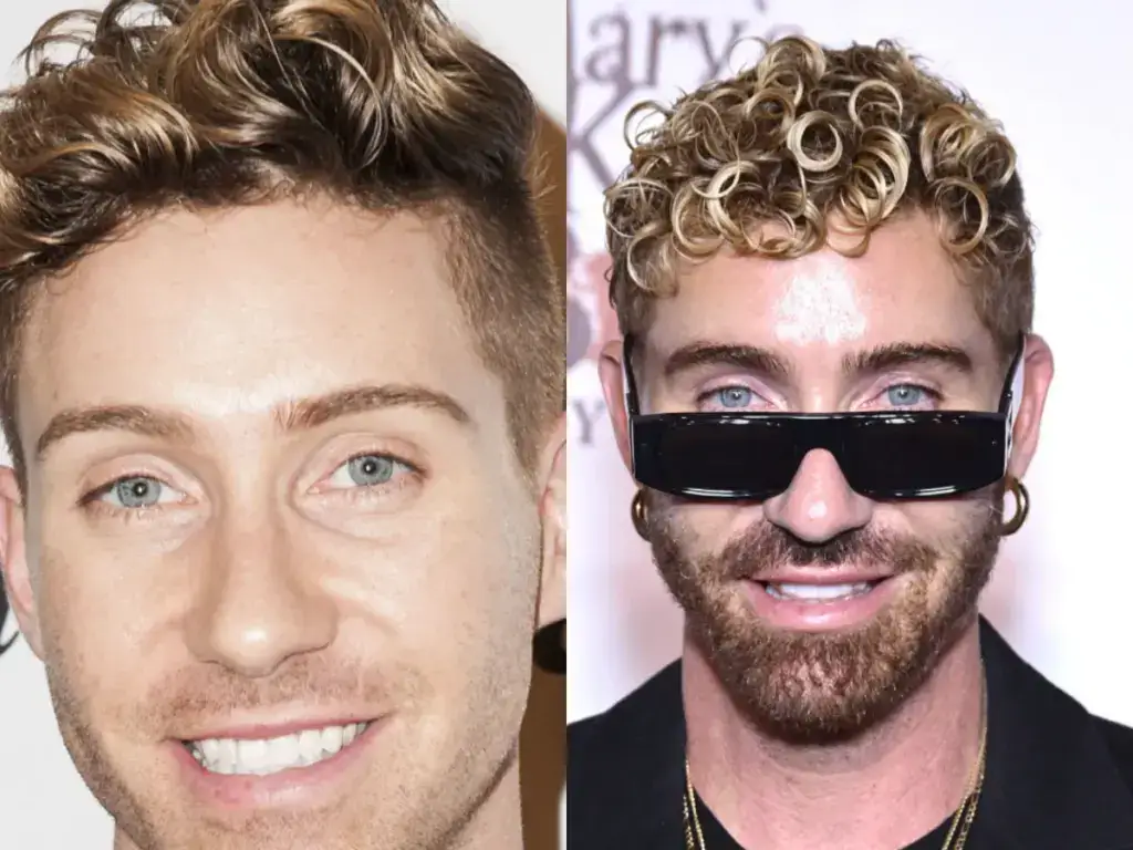 bobby newberry teeth before after