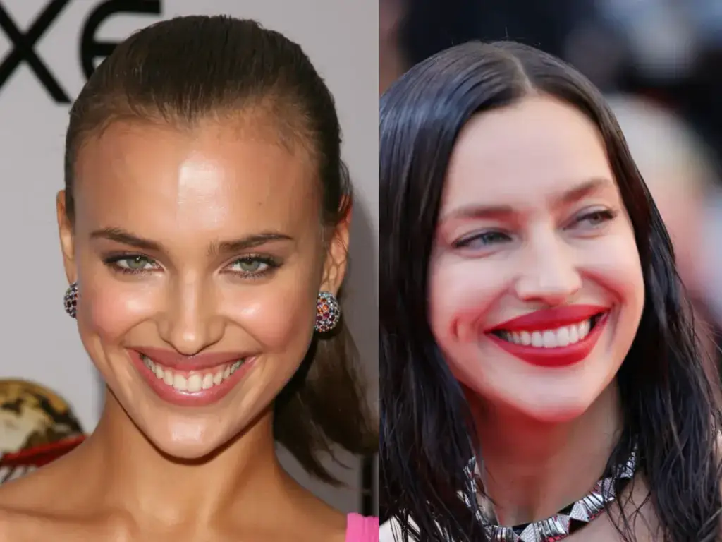 irina shayk dents avant apr&egrave;s