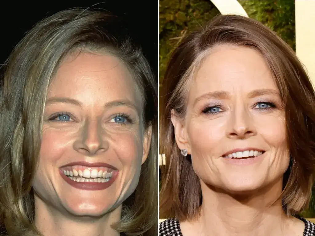 jodie-foster-teeth-before-after
