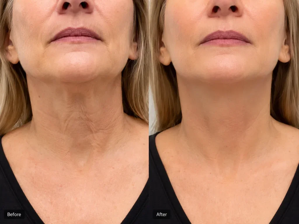 neck lift before and after