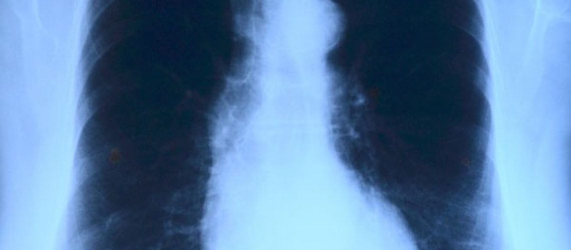 mesothelioma-charlotte-workers-compensation-lawyer mesothelioma-charlotte-workers-compensation-lawyer