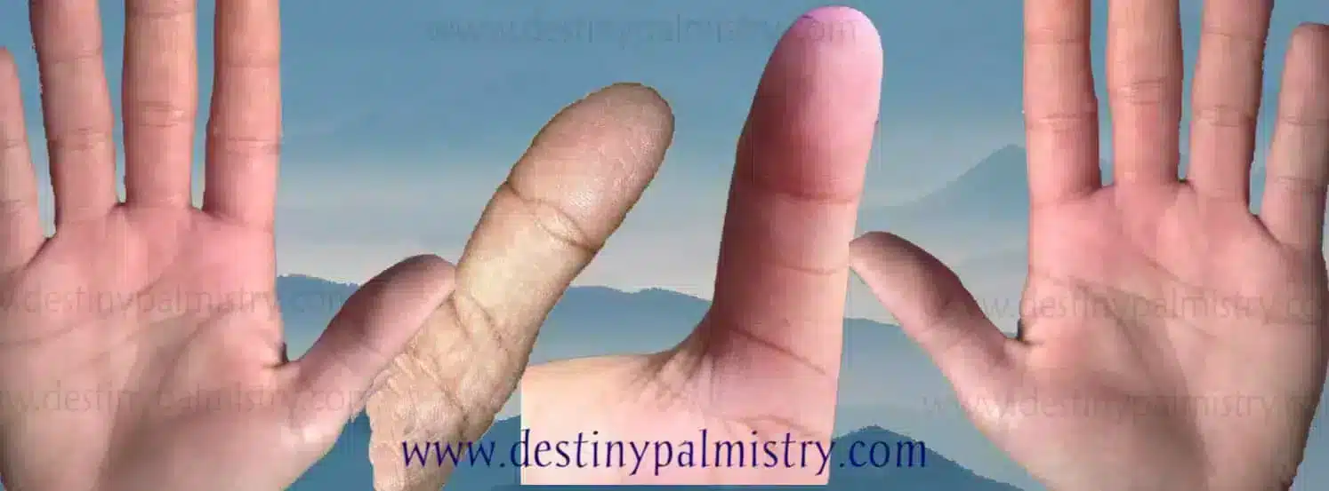 stiff thumb, short thumb