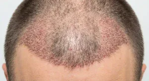 post hair transplant scalp showing shock loss