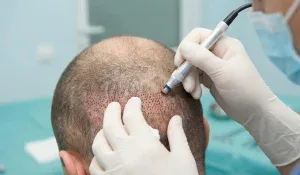 hair transplant surgical scalp trauma