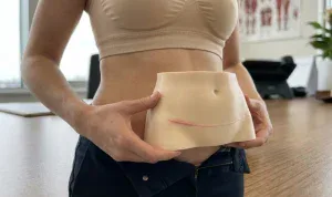 anatomical model showing tummy tuck scar placement