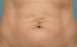long term liposuction result affected by natural aging and skin laxity