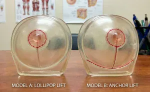 anatomical breast models lollipop vs anchor scars
