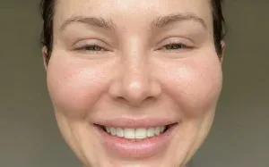 woman smiling excessive cheek filler pillow face effect