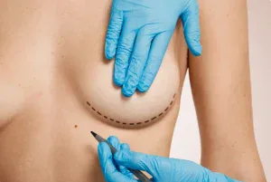 breast augmentation