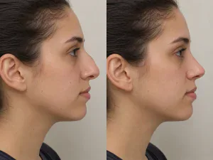 dorsal hump before and after