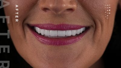 dental implants before after