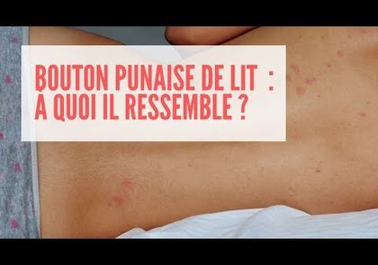 0 - Piqure de punaise de lit: le guide ultime !
