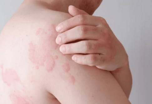 Bouton qui gratte comme une piqûre de moustique image 67 - Bouton qui gratte comme une piqûre de moustique