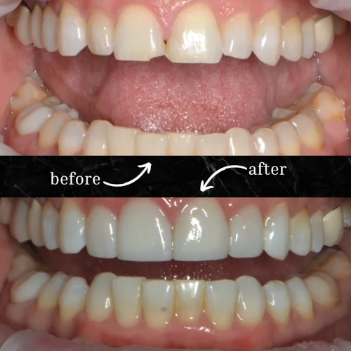 Before and After Veneer Cosmetic Dental Procedure