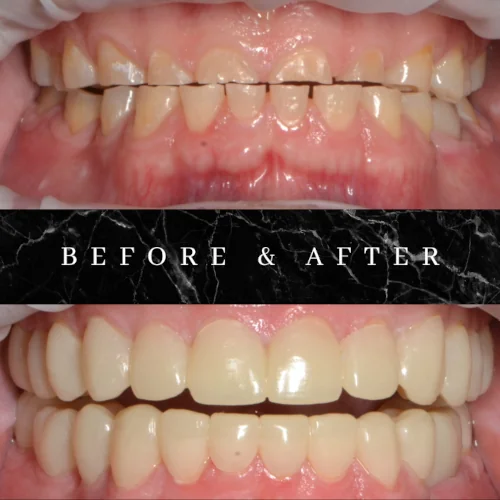 Before and After Aesthetic Dental Procedure Dr Suffoletta