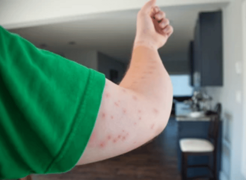 Bouton qui gratte comme une piqûre de moustique image 65 - Bouton qui gratte comme une piqûre de moustique