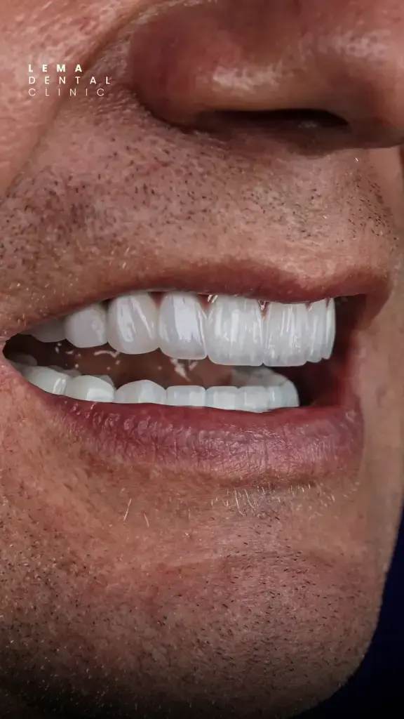 hollywood smile after photo lema dental clinic 5