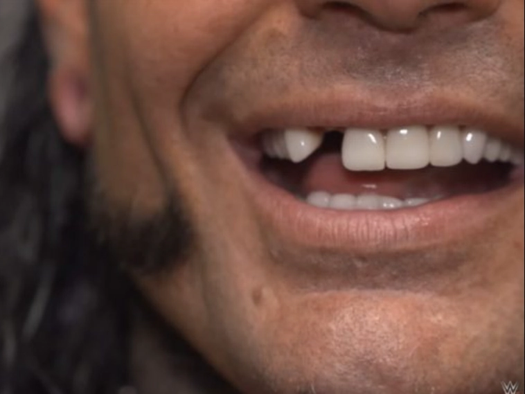 jeff hardy skade