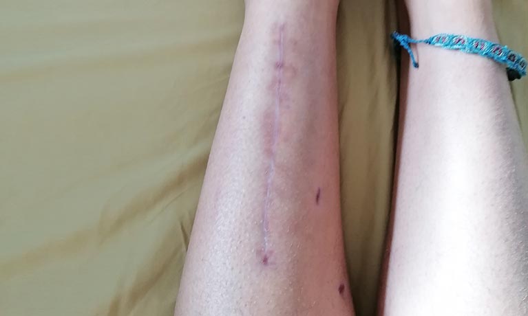 Leg after surgery showing scar