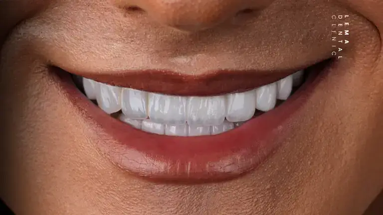 dental implants turkey: d4381-dental-code
