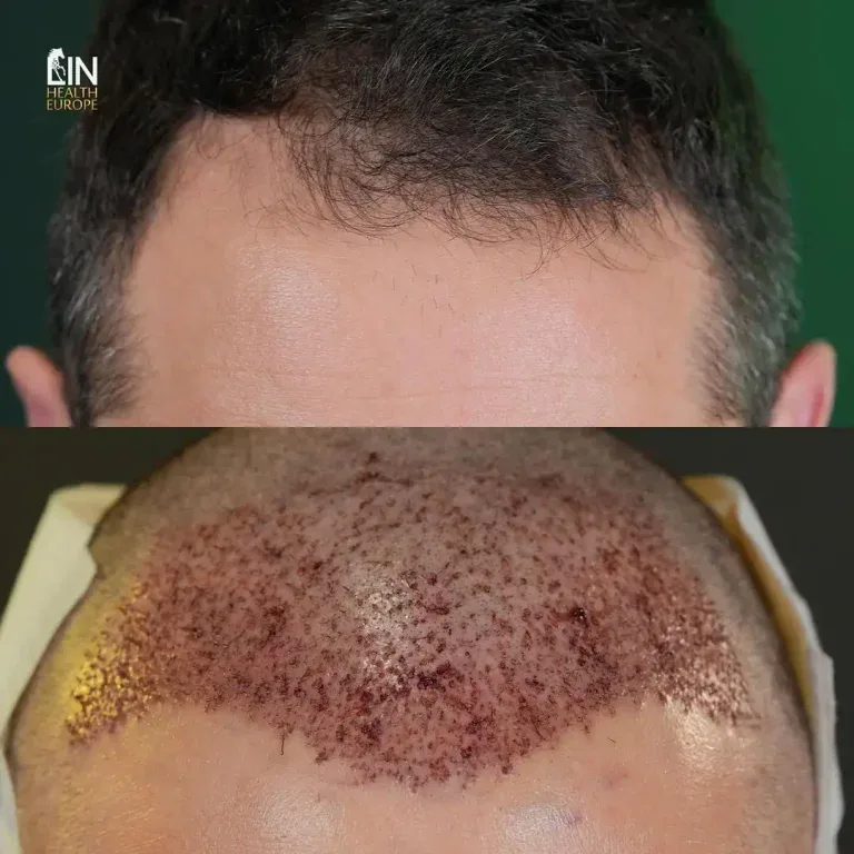 lin-hair-transplant-before-after