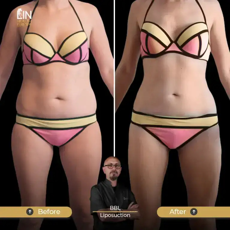 Lipo