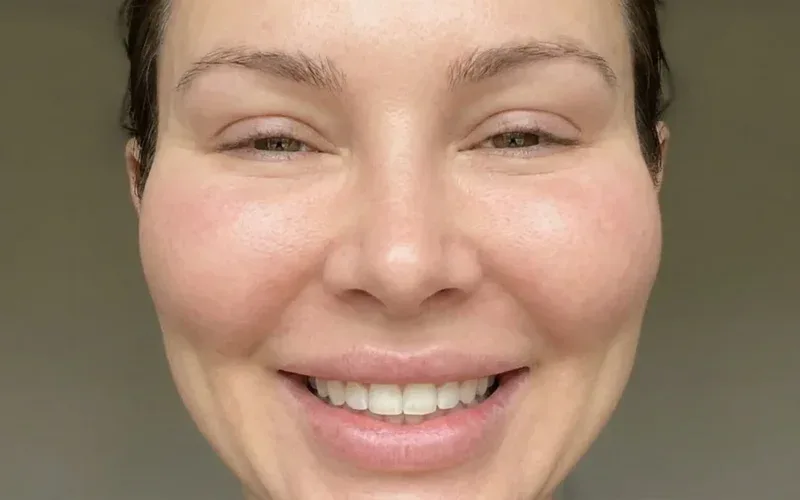 woman smiling excessive cheek filler pillow face effect