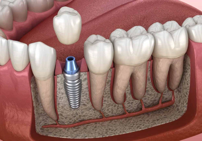 innesto osseo dentale
