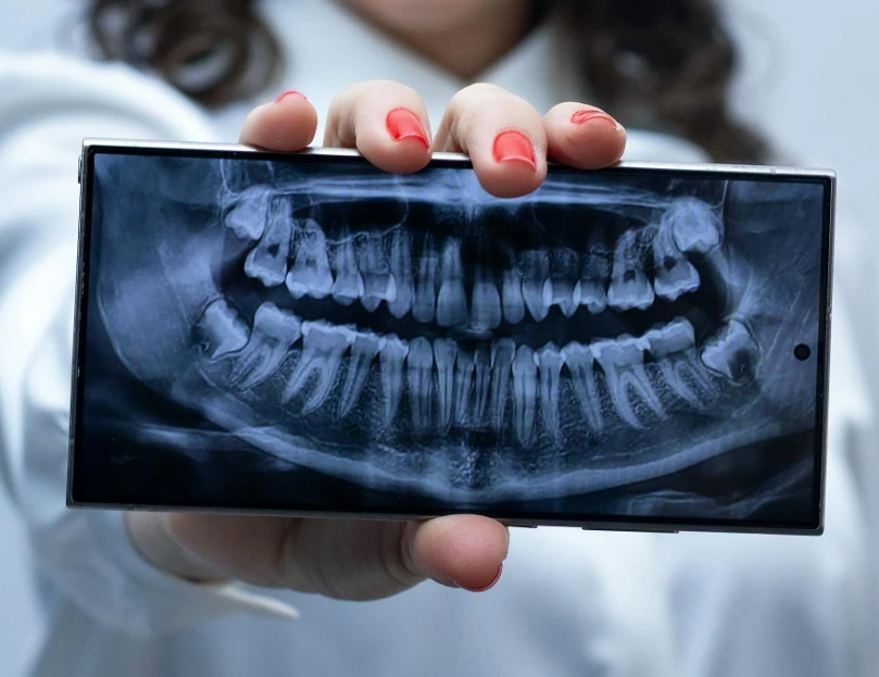 radiographie des dents