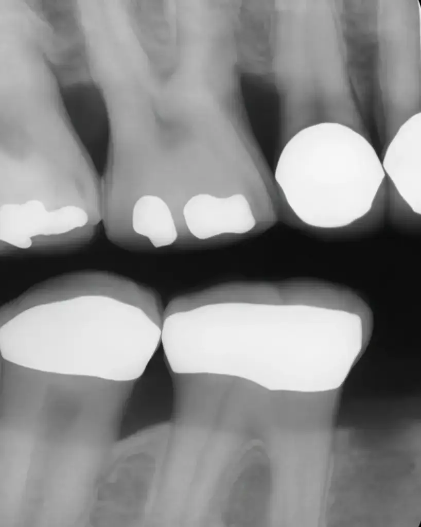 dental-code-for-6-vertical-bitewings-D0274