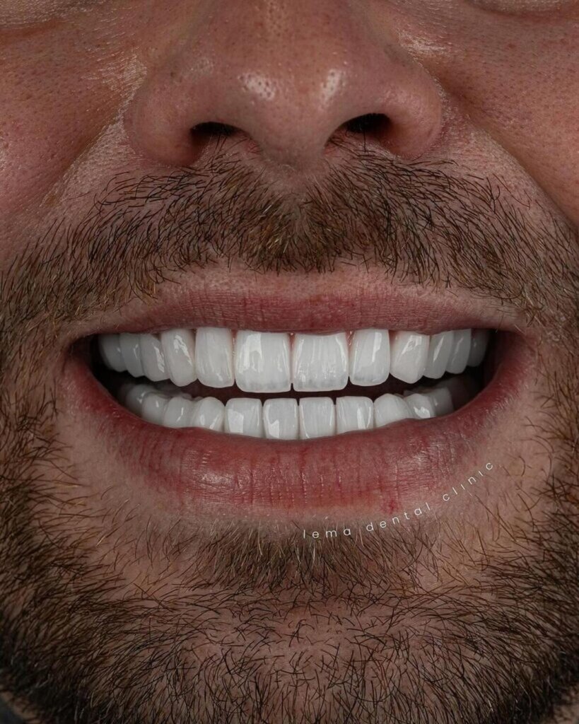 Hollywood hvitt smil