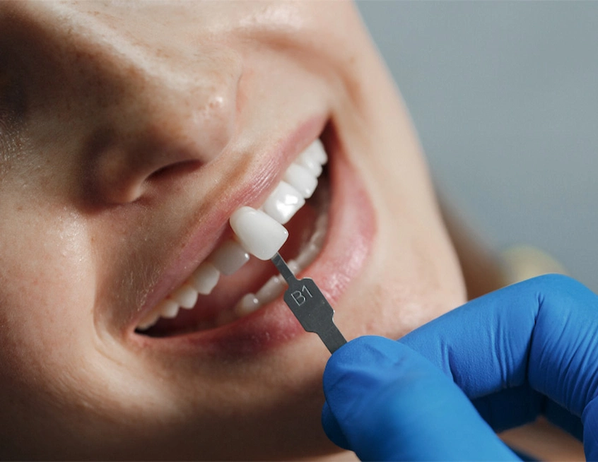 coroane dentare