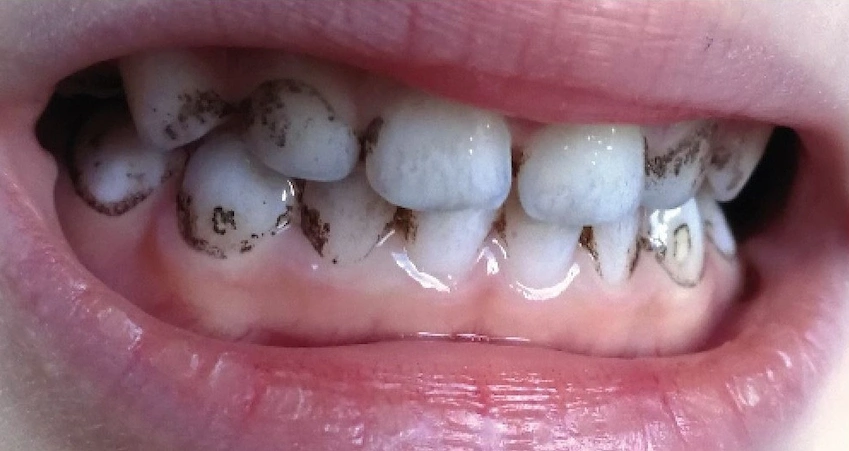 black stains teeth