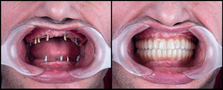 visos burnos implantas