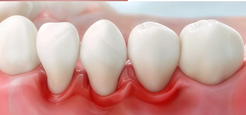 loose teeth