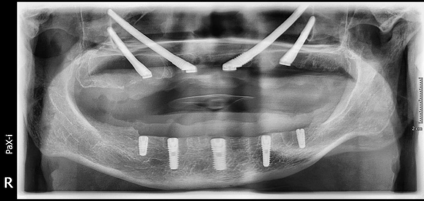 zygomatic implants in istanbul turkey