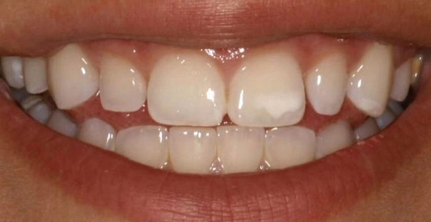 desmineralizaci&oacute;n de dientes