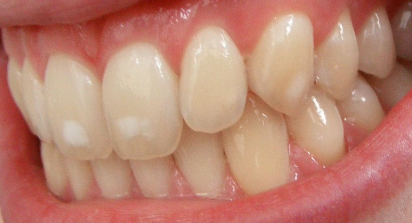 manchas de flúor nos dentes